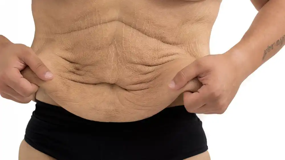 RF Microneedling for Loose Skin: How Can It Help Tighten and Reshape the Skin Willenhall?